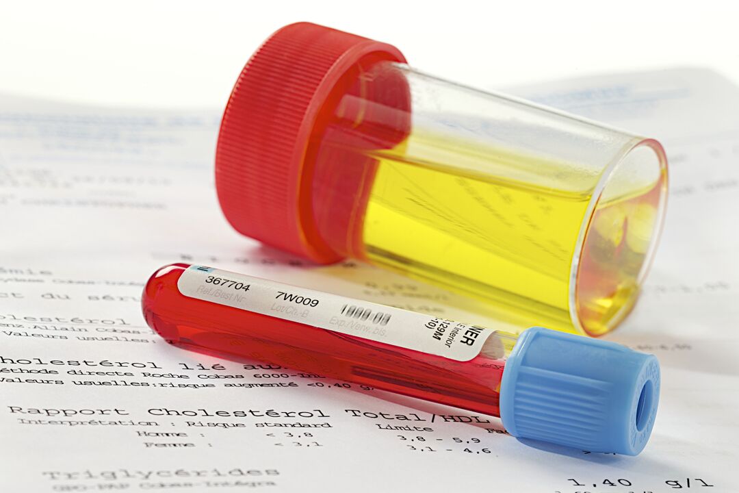Ein Blut- und Urintest hilft, das Vorhandensein einer Prostatitis festzustellen.