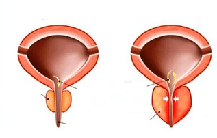 Was ist akute Prostatitis