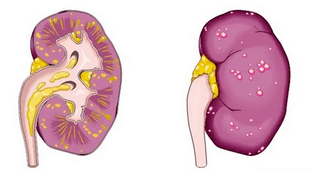 was verursacht akute Prostatitis