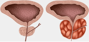 Was ist Prostatitis