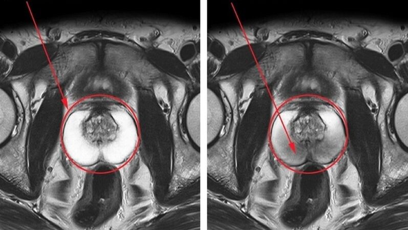 eine gesunde, entzündete Prostata mit chronischer Prostatitis