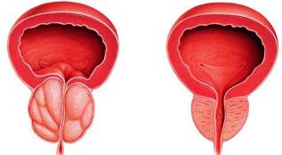 der unterschied krank und gesund für die prostata